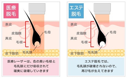 脱毛の仕組み